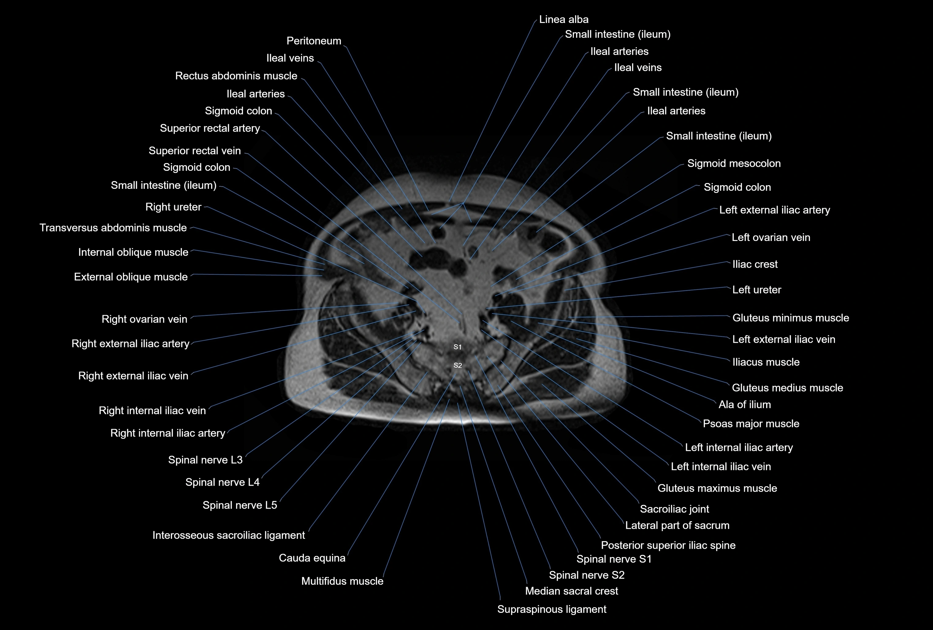 MRI Abdomen axial cross sectional anatomy radiology  image-img-00001-00042.webp